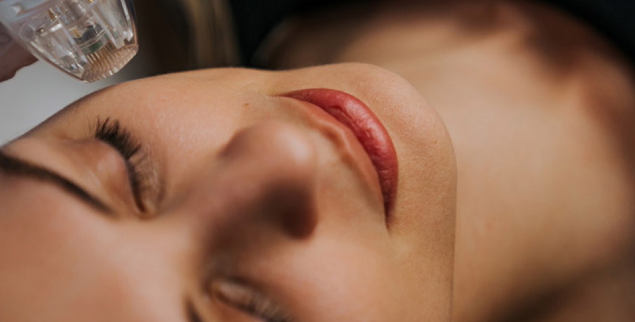 Visage Microneedling RF