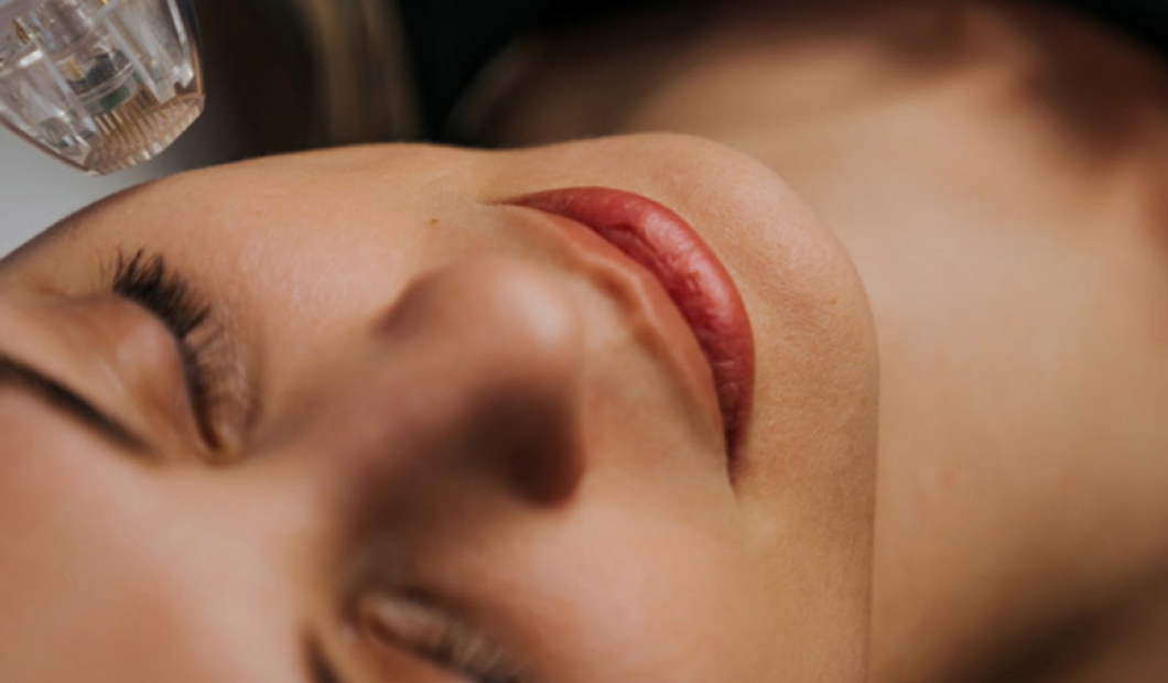 Visage Microneedling RF