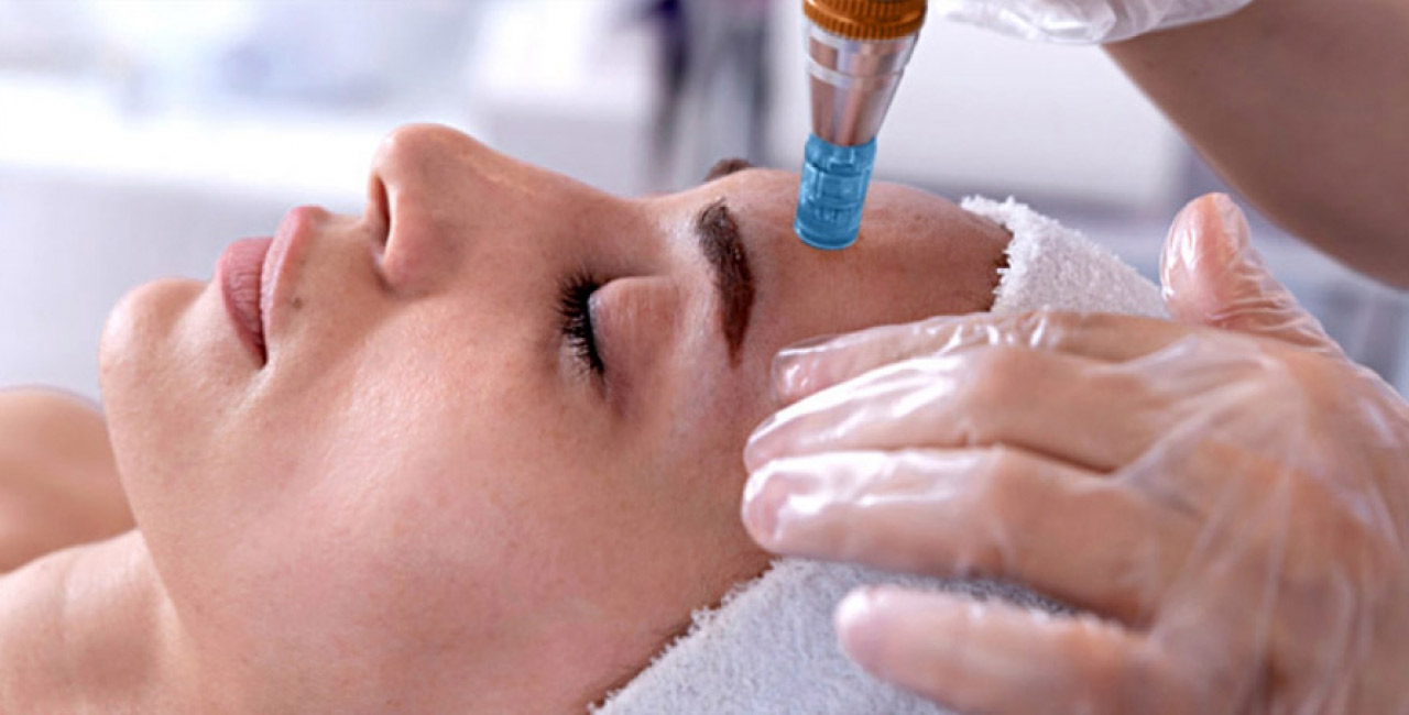 Microneedling-Behandlung
