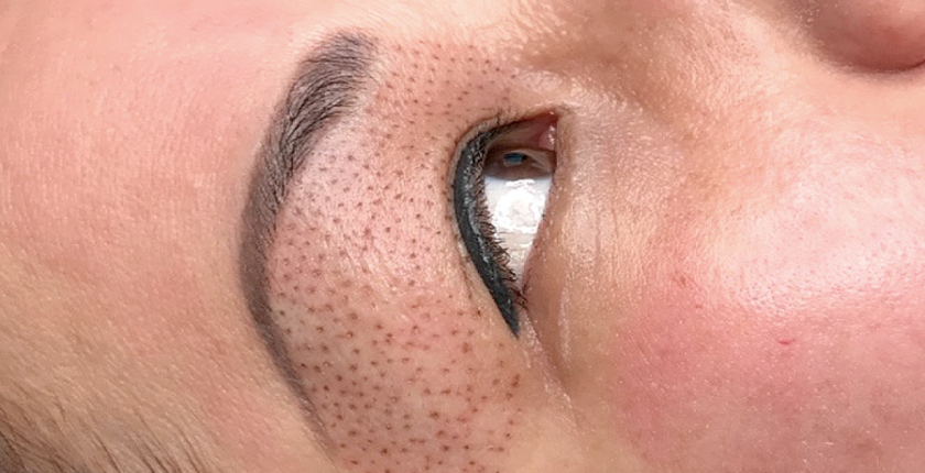 Plasma Skin Technologie